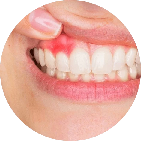 Баннер Лечение пародонтита в Санкт-Петербурге Баннер Лечение пародонтита в Санкт-Петербурге